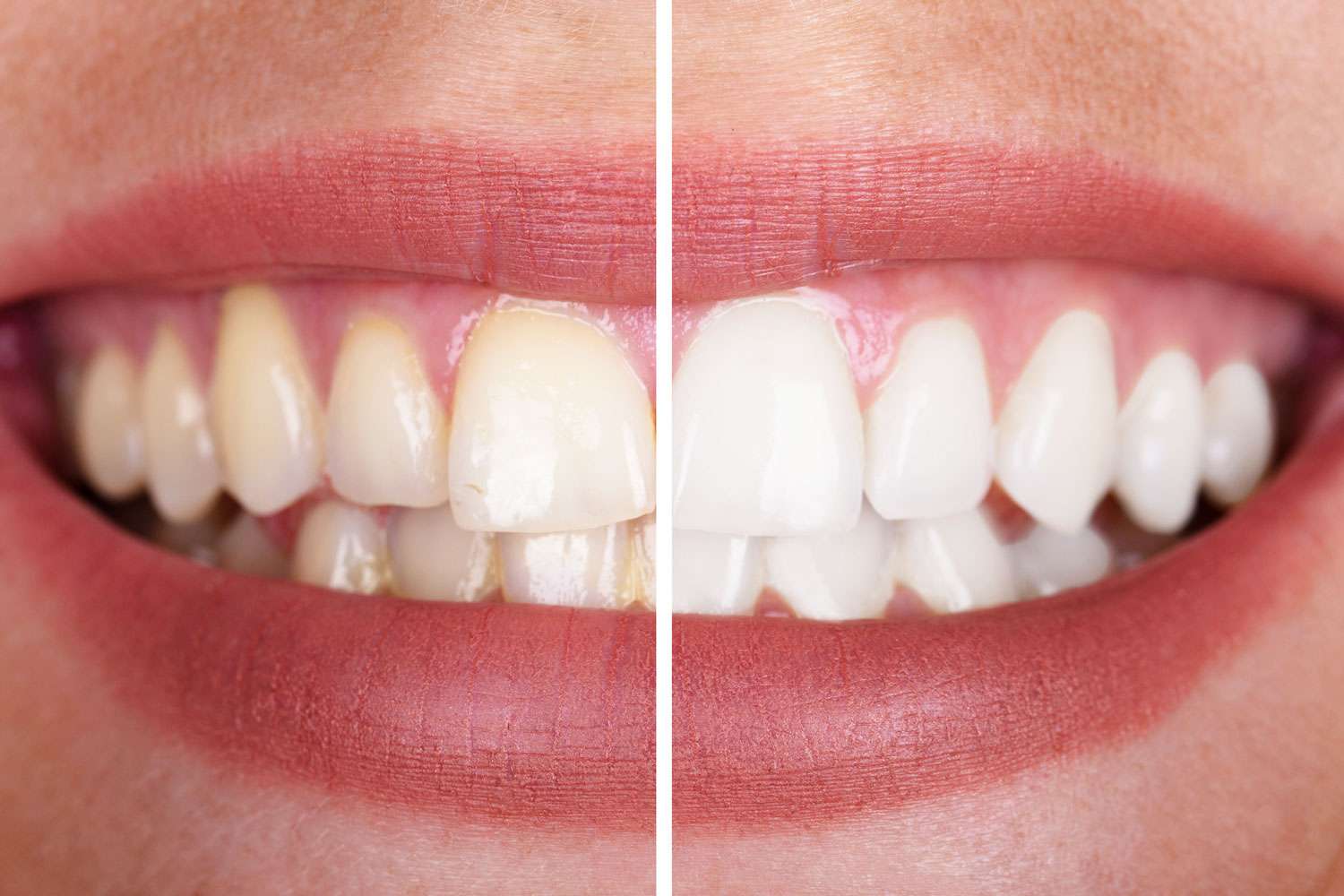 Teeth Whitening Services